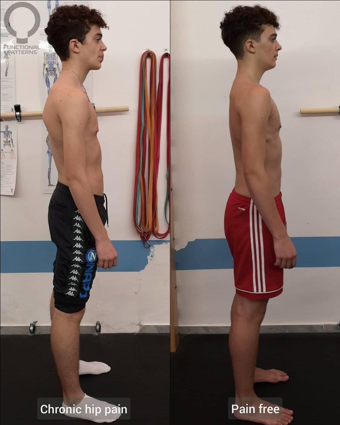 Chronic Hip Pain Gains