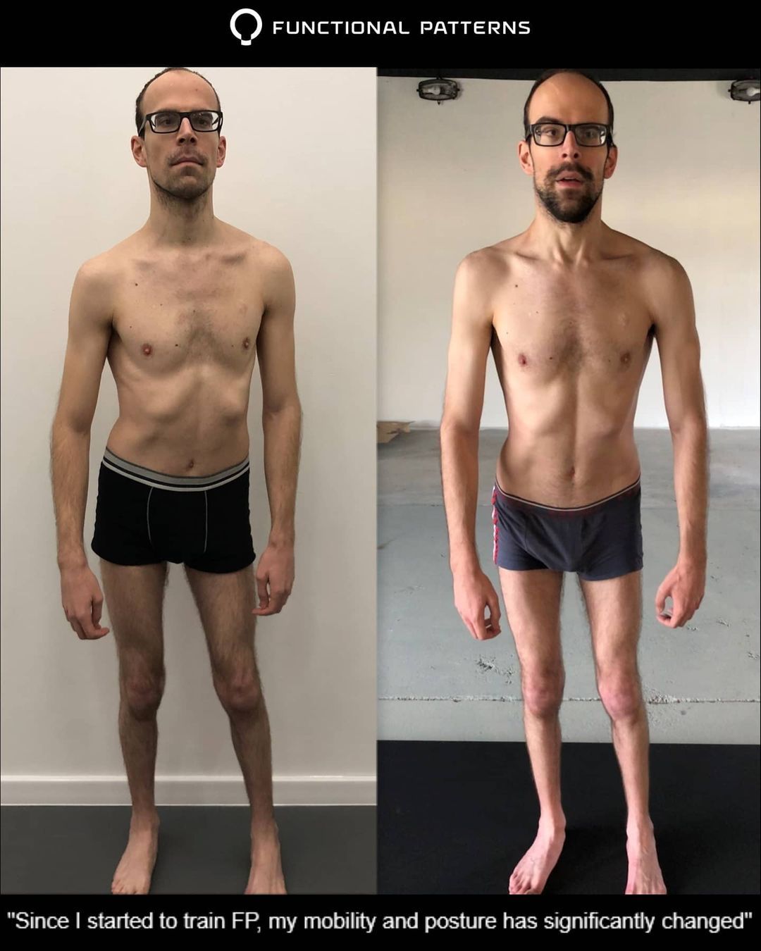 Cerebral Palsy Mass And Structure Gains Without Pains