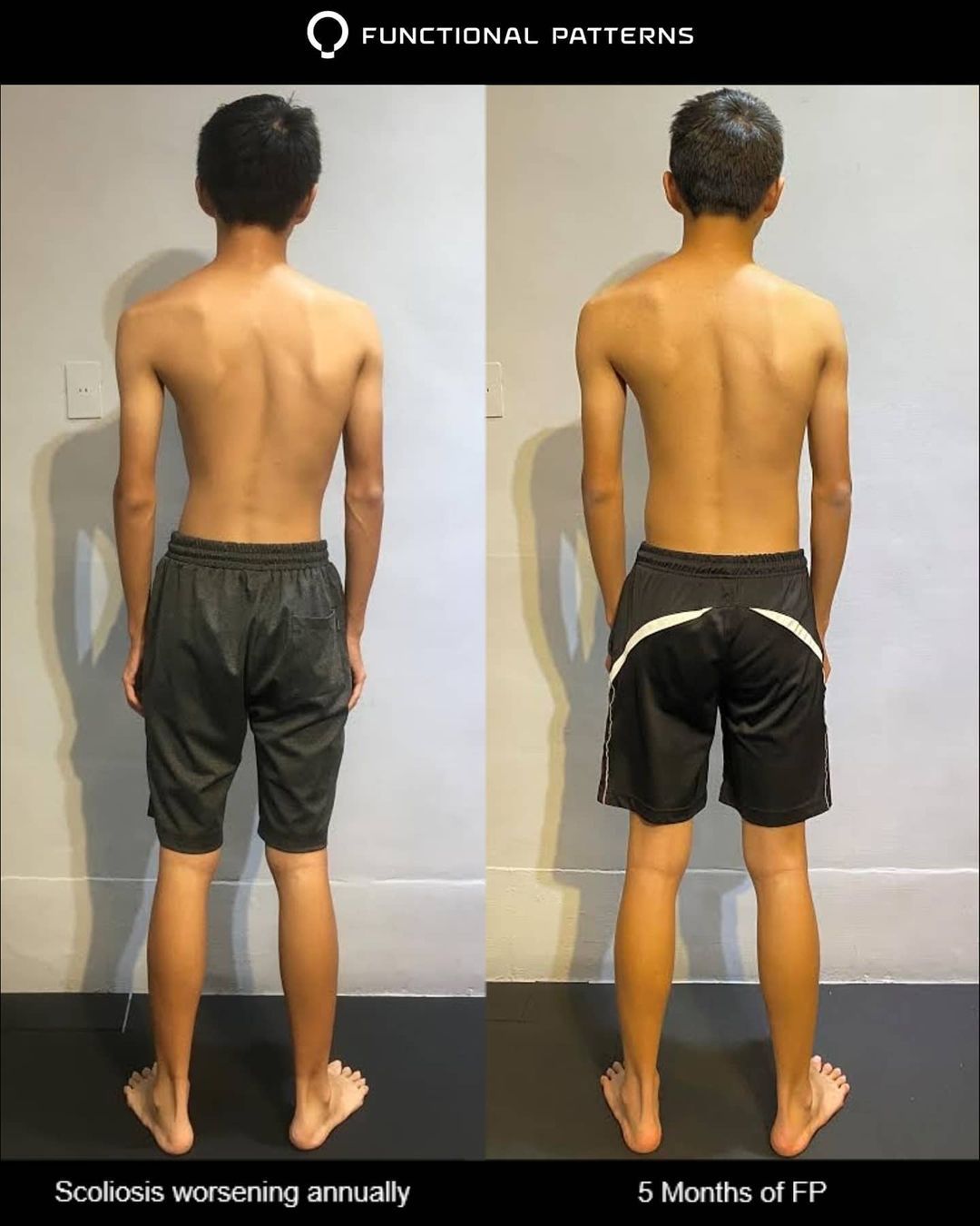 5 Month Scoliosis Gains Functional Patterns