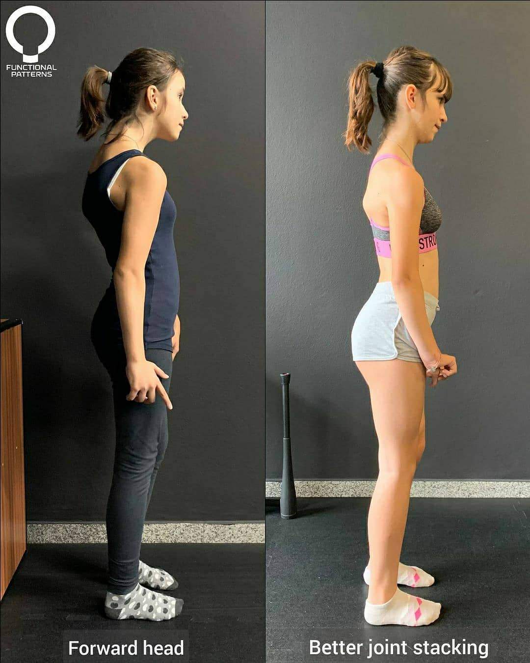Cerebral Palsy Posture Gains