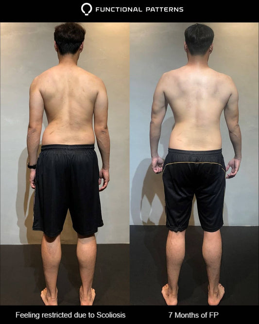 7 Month Scoliosis Gains