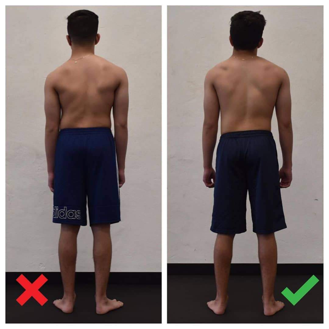Scoliosis Structure Gains from Certified HBS practitioner by Functional Patterns