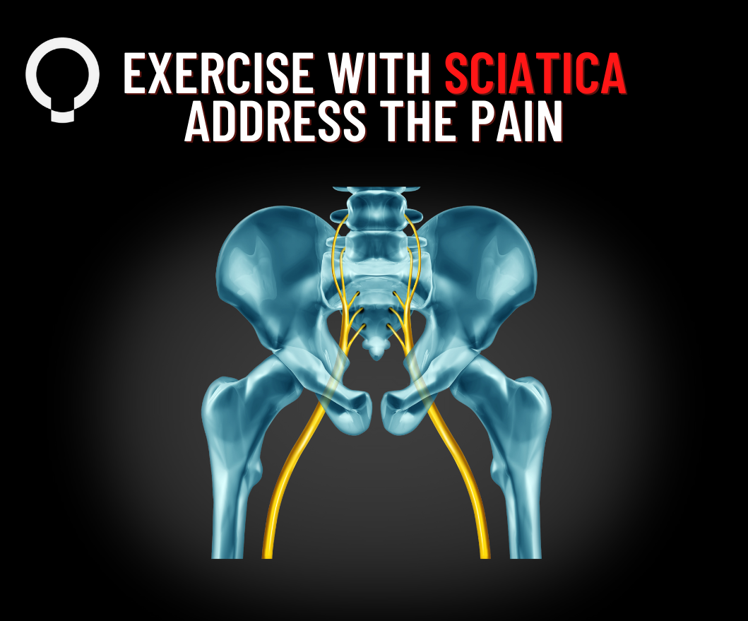 Exercising with Sciatica, Addressing the Pain
