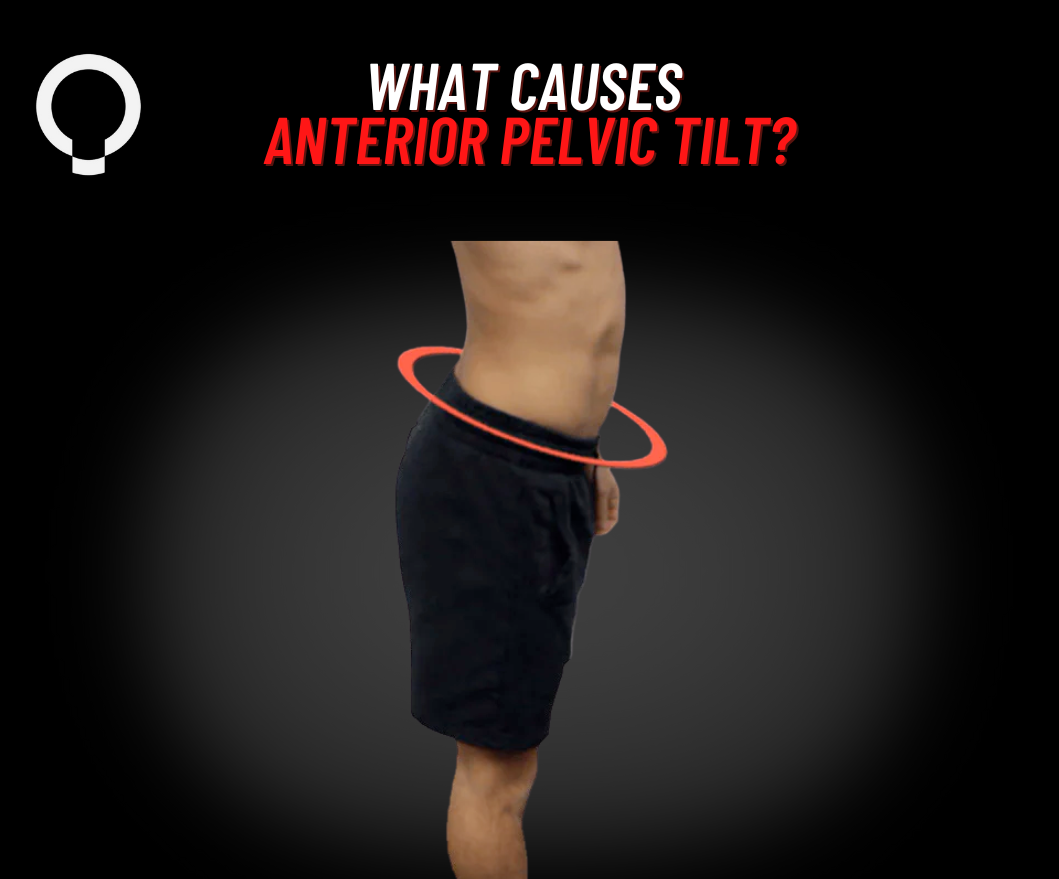 What causes an Anterior Pelvic Tilt?