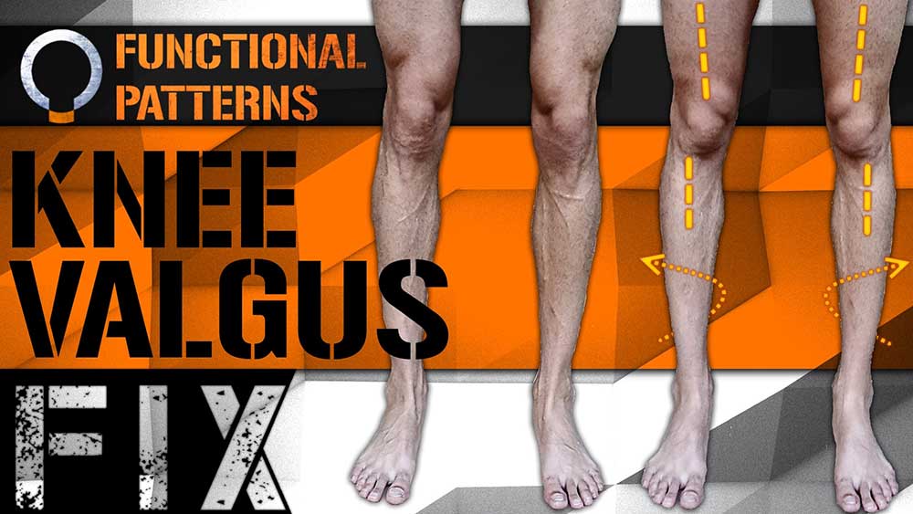 Knee Valgus: Correcting a Knee Valgus for the Long Term