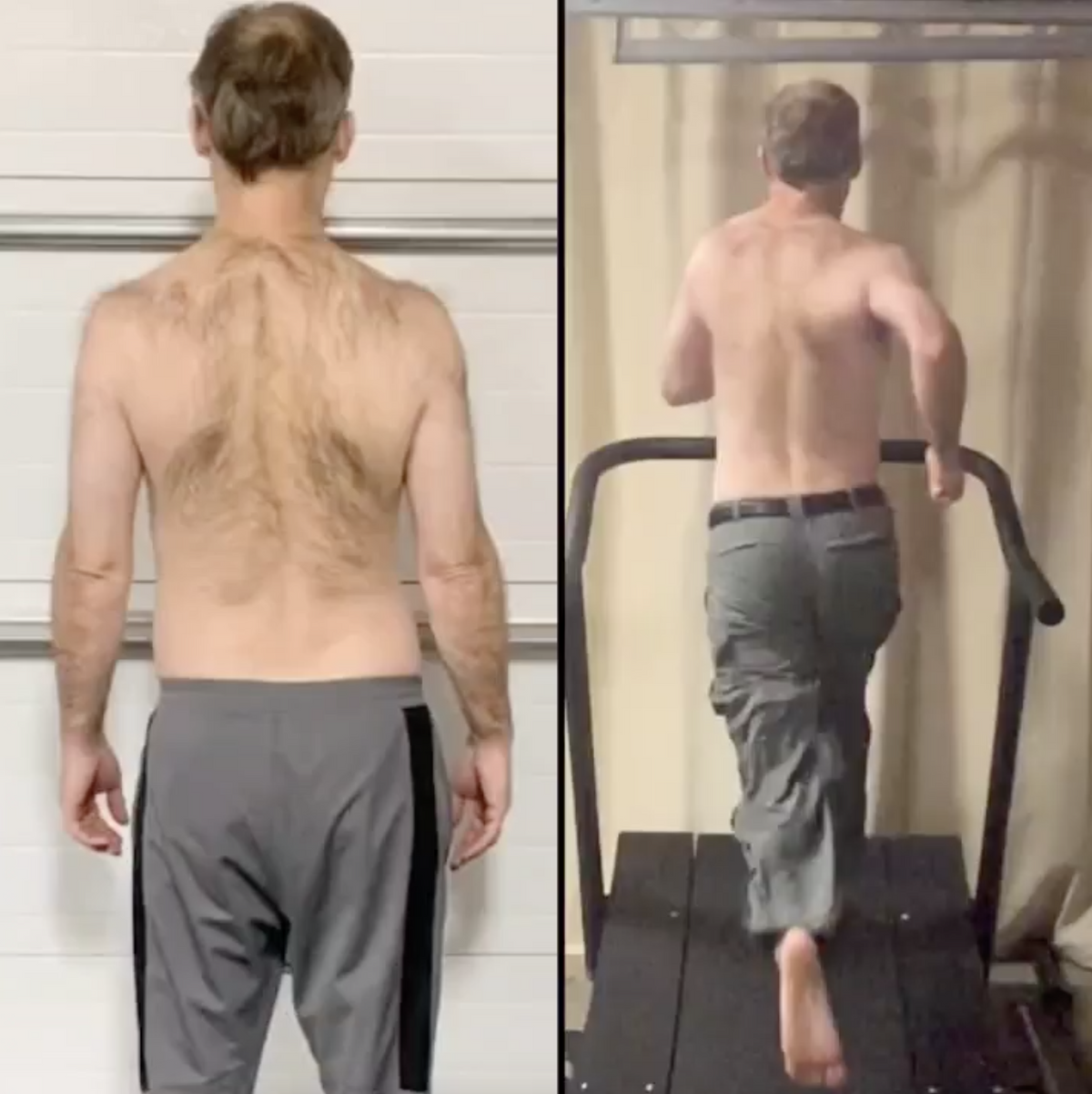 From Disc Herniation To Pain Free Sprinting