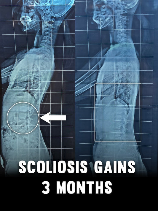 Scoliosis Improvements in 3 Months