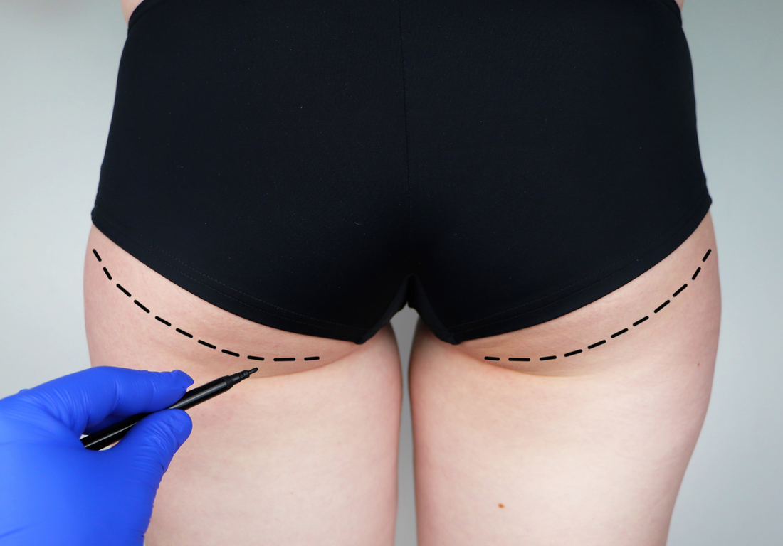 Hazards and Other Unfavorable Outcomes of the Brazilian Butt Lift