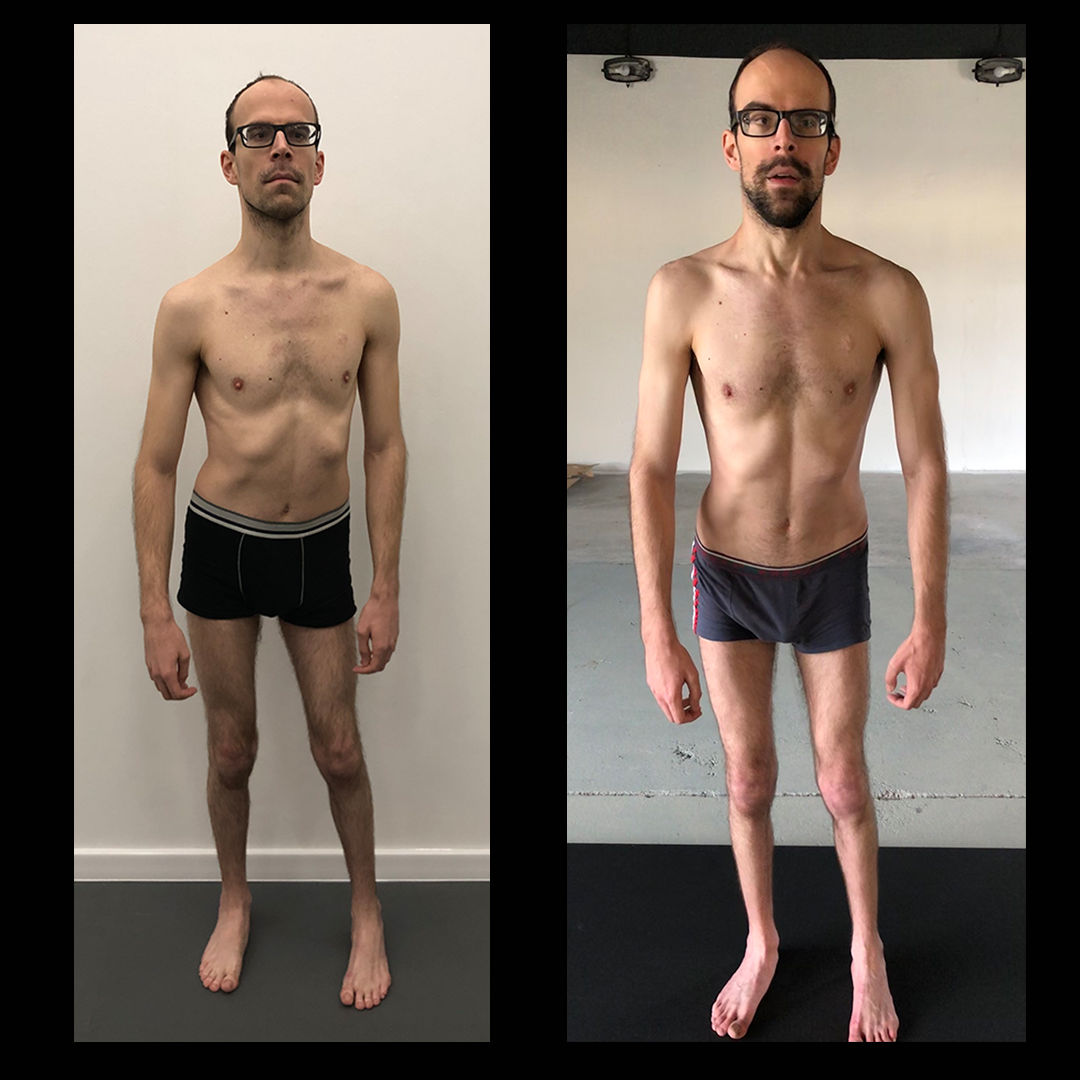 Cerebral Palsy improvements