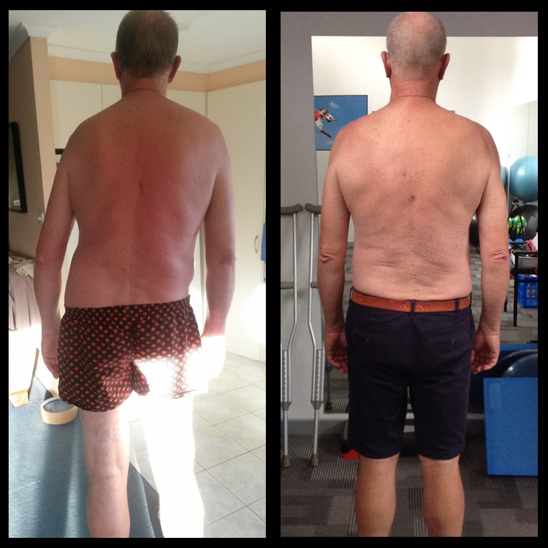 Scoliosis gains & Pain-free lower back post disc bulge