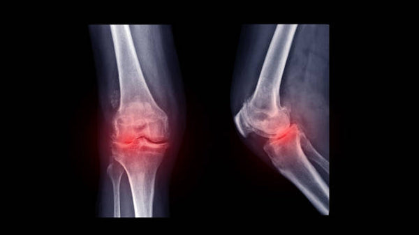 From Knock Knees to Strong Knees: The Functional Patterns Approach